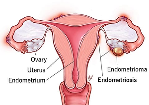 Endometriosis