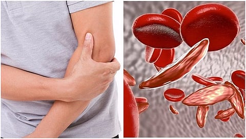 Sickle Cell anemia