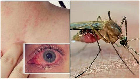 Zika Virus (file pic)