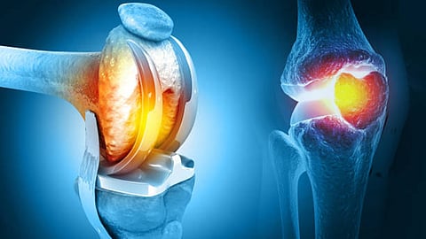 Knee replacement Surgery
