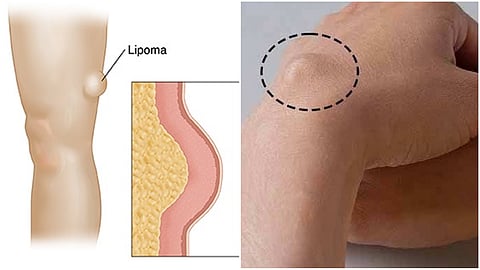 Lipoma (file pic)