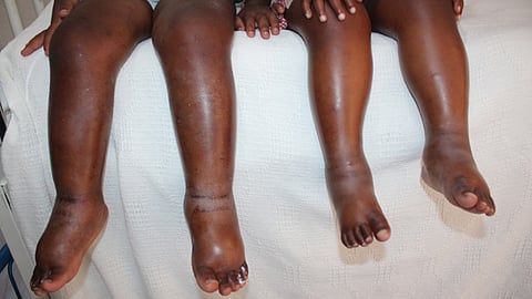 Kwashiorkor malnutrition