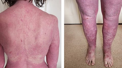 ಹೈಪರ್ ಐಜಿಇ ಸಿಂಡ್ರೋಮ್: ಕಾರಣಗಳು, ಚಿಕಿತ್ಸೆ ಮತ್ತು ತಡೆಗಟ್ಟುವಿಕೆ (ಕುಶಲವೇ ಕ್ಷೇಮವೇ)