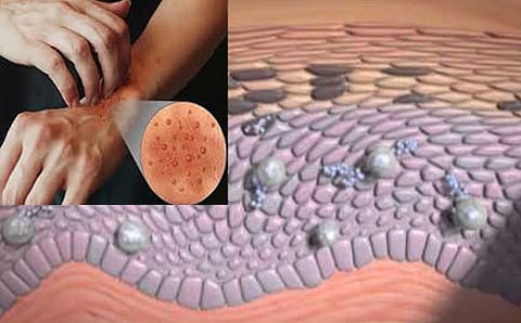 ಸೋರಿಯಾಇಸಿಸ್