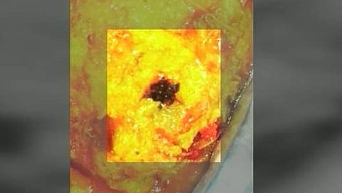 ಉಪಾಹಾರದಲ್ಲಿ ನೊಣ ಪತ್ತೆ
