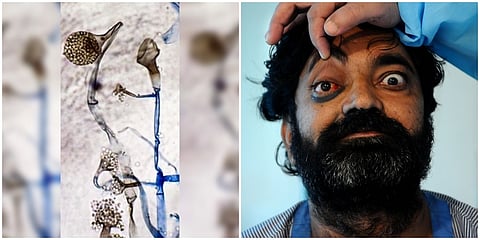 ಬ್ಲ್ಯಾಕ್ ಫಂಗಸ್ ನ ಲಕ್ಷಣಗಳು (ಸಂಗ್ರಹ ಚಿತ್ರ)