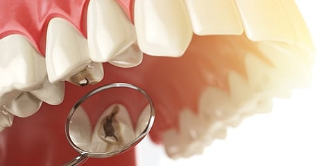 ಹುಳುಕು ಹಲ್ಲು (ಸಂಗ್ರಹ ಚಿತ್ರ)