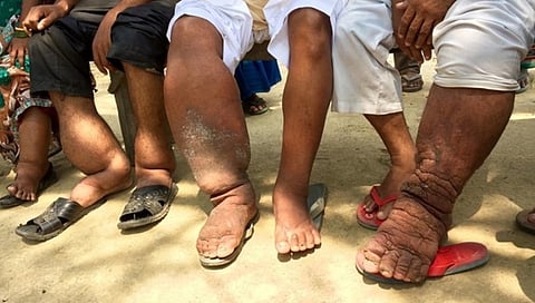 ಆನೆಕಾಲು ರೋಗ