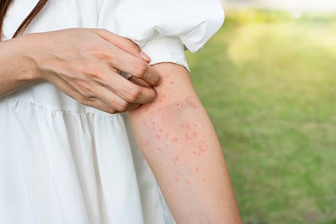 Heat rash
