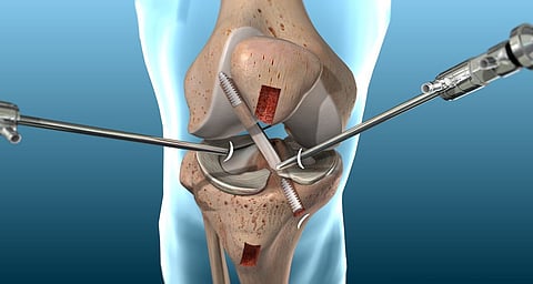 Ligament Tears