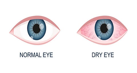 DRY EYE