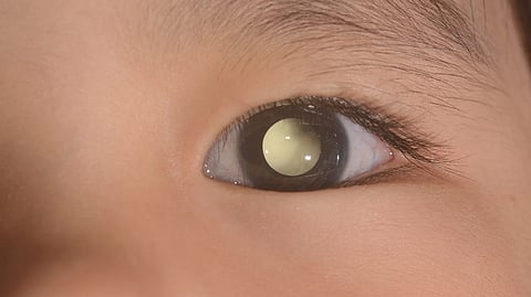 retinoblastoma