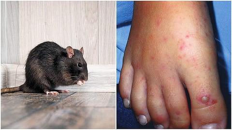 Rat fever