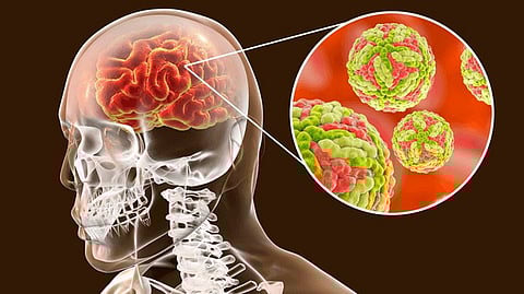 Encephalitis