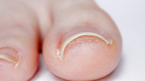 toenail