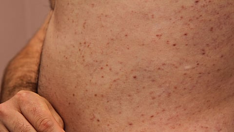 hiatus hernia