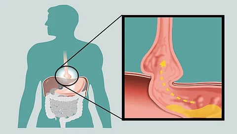 hiatus hernia