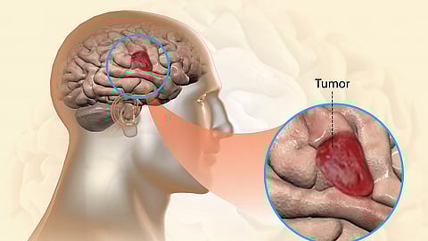 Glioblastoma 