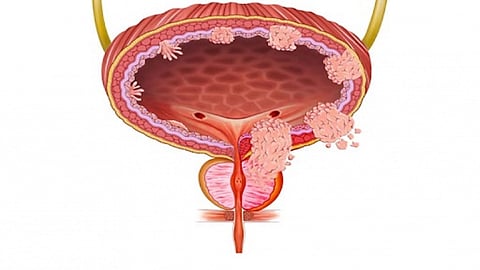 Urinary Bladder Cancer