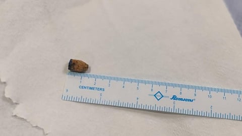 pen cap in lung, undergoes successful surgery