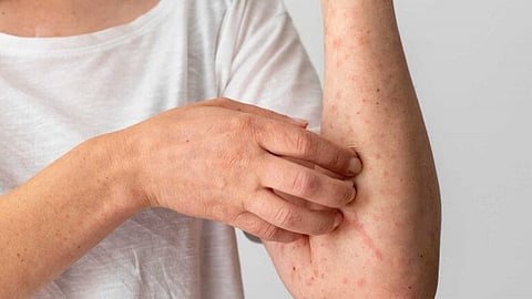 Pruritus