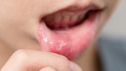 Mouth Ulcers
