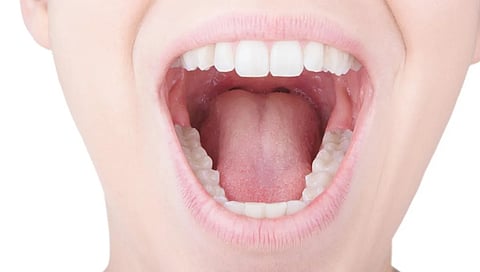oral myiasis (file pic)