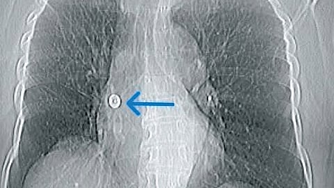In a rare and complex intervention, doctors retrieved the pin using a minimally invasive bronchoscopic technique involving a Fogarty balloon catheter.