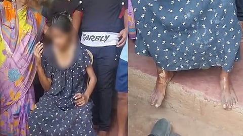 The minor girl who suffered serious burns