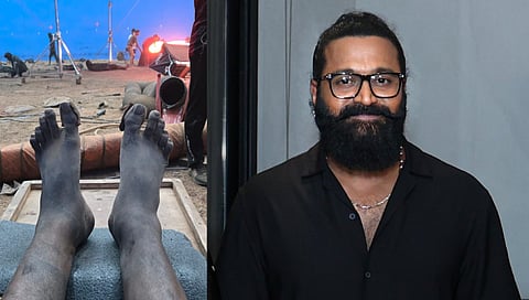 Swollen leg - Rishab Shetty 