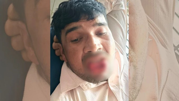Man Tries To Forcibly Kiss Ex-Girlfriend She Bites Off His Tongue