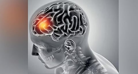 ಬ್ರೇನ್ ಅನ್ಯುರಿಸಮ್