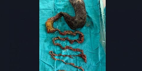 ಹೊಟ್ಟೆಯಿಂದ ಹೊರತೆಗೆದಿರುವ ಕೂದಲು