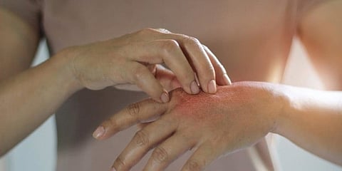 ಸೋರಿಯಾಸಿಸ್ (ಸಂಗ್ರಹ ಚಿತ್ರ)