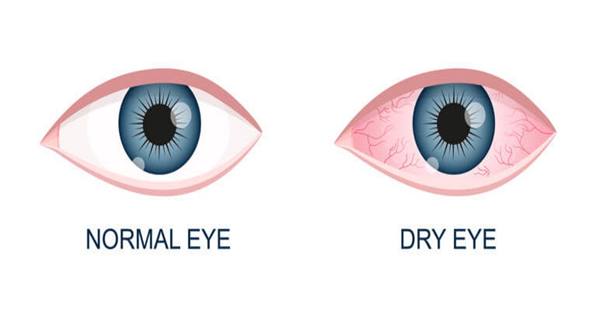 DRY EYE ಸಿಂಡ್ರೋಮ್ ಅಥವಾ ಶುಷ್ಕ ನೇತ್ರ ಸಮಸ್ಯೆ (ಕುಶಲವೇ ಕ್ಷೇಮವೇ)
