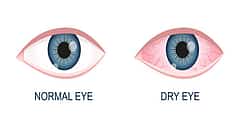 DRY EYE ಸಿಂಡ್ರೋಮ್ ಅಥವಾ ಶುಷ್ಕ ನೇತ್ರ ಸಮಸ್ಯೆ (ಕುಶಲವೇ ಕ್ಷೇಮವೇ)