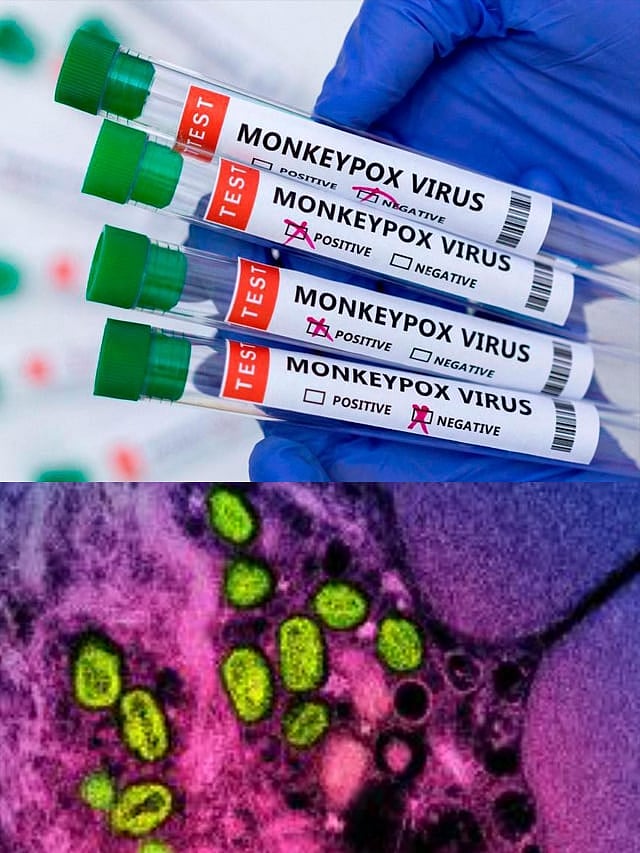 Mpox ಮಾರಣಾಂತಿಕವೇ?': ಮಂಕಿಪಾಕ್ಸ್ ಸಾಂಕ್ರಾಮಿಕ ಬಗ್ಗೆ ಇನ್ನಷ್ಟು ತಿಳಿಯಿರಿ