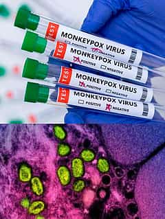 Mpox ಮಾರಣಾಂತಿಕವೇ?': ಮಂಕಿಪಾಕ್ಸ್ ಸಾಂಕ್ರಾಮಿಕ ಬಗ್ಗೆ ಇನ್ನಷ್ಟು ತಿಳಿಯಿರಿ