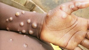 ಮಂಕಿಪಾಕ್ಸ್ ಅಥವಾ Mpox: ರೋಗ ಲಕ್ಷಣಗಳು ಮತ್ತು ಚಿಕಿತ್ಸೆ (ಕುಶಲವೇ ಕ್ಷೇಮವೇ)