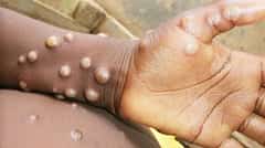 ಮಂಕಿಪಾಕ್ಸ್ ಅಥವಾ Mpox: ರೋಗ ಲಕ್ಷಣಗಳು ಮತ್ತು ಚಿಕಿತ್ಸೆ (ಕುಶಲವೇ ಕ್ಷೇಮವೇ)