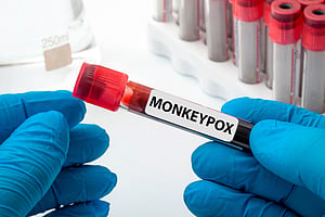 ಮಂಗಳೂರಿನಲ್ಲಿ ಮೊದಲ Mpox ಪ್ರಕರಣ ವರದಿ; ಉಡುಪಿಯ 40 ವರ್ಷದ ವ್ಯಕ್ತಿಯ ಪರೀಕ್ಷೆಯಲ್ಲಿ ಪಾಸಿಟಿವ್