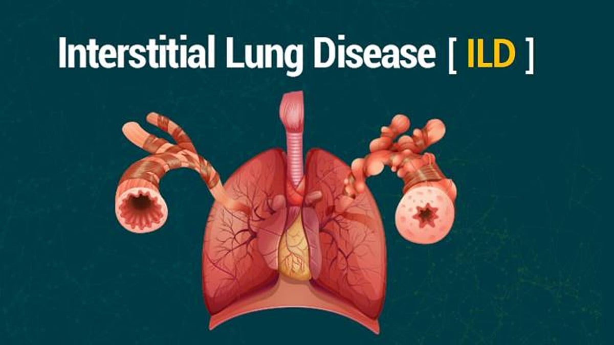 ILD ಅಥವಾ ಇಂಟರ್ಸ್ಟಿಶಿಯಲ್ ಲಂಗ್ ಡಿಸೀಸ್ (ಕುಶಲವೇ ಕ್ಷೇಮವೇ)