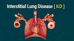 ILD ಅಥವಾ ಇಂಟರ್ಸ್ಟಿಶಿಯಲ್ ಲಂಗ್ ಡಿಸೀಸ್ (ಕುಶಲವೇ ಕ್ಷೇಮವೇ)