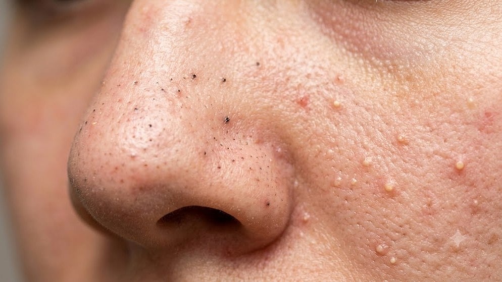 Blackheads/whiteheads ಸಮಸ್ಯೆ ಶಾಶ್ವತವಾಗಿ ದೂರಾಗಿಸುವುದು ಹೇಗೆ..? ಇಲ್ಲಿದೆ ಸಿಂಪಲ್ ಟಿಪ್ಸ್...