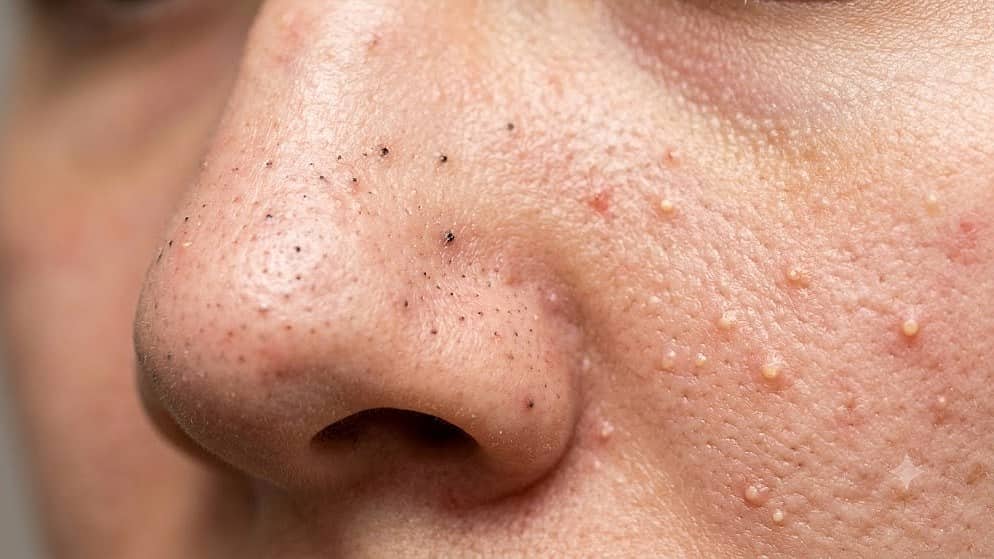 Blackheads/whiteheads ಸಮಸ್ಯೆ ಶಾಶ್ವತವಾಗಿ ದೂರಾಗಿಸುವುದು ಹೇಗೆ..? ಇಲ್ಲಿದೆ ಸಿಂಪಲ್ ಟಿಪ್ಸ್...
