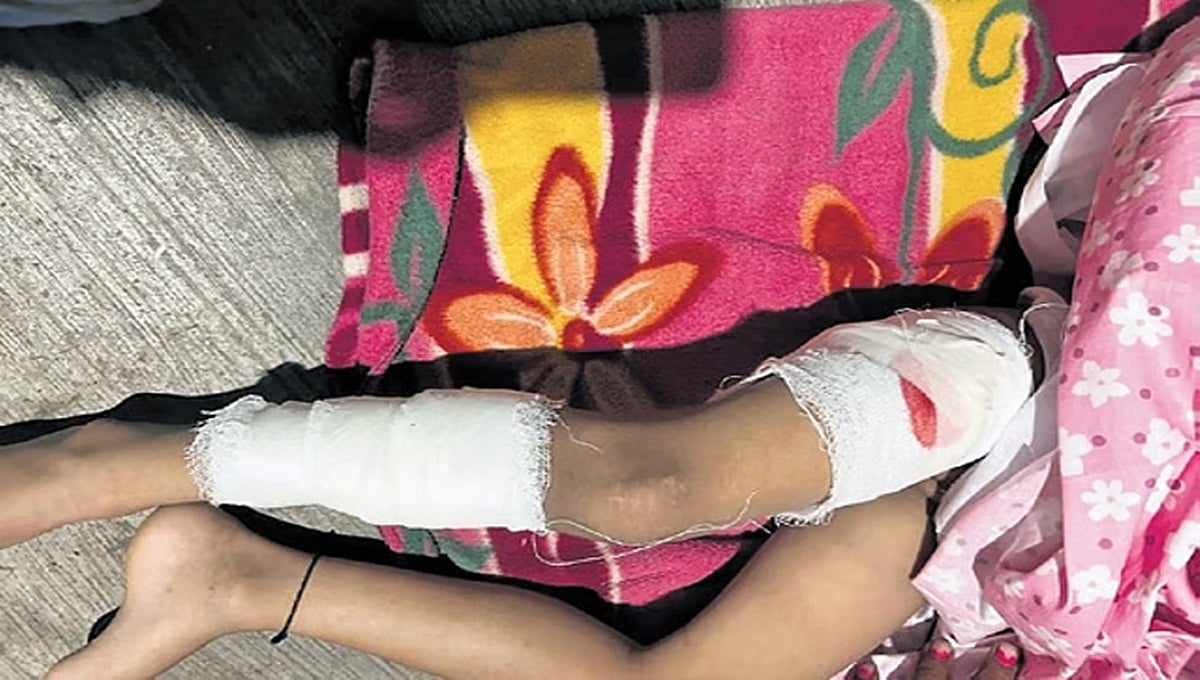ಬೆಂಗಳೂರು: ಬಾಲಕಿ ಮೇಲೆ ನಾಯಿಗಳ ದಾಳಿ; ಉತ್ತರ ನಗರ ಪಾಲಿಕೆಯಿಂದ ಶ್ವಾನ ಹಿಡಿಯುವ ಕಾರ್ಯಾಚರಣೆ!
