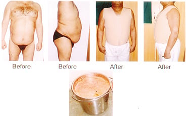 ಲೈಪೋಸಕ್ಷನ್ನಿಂದ ಲೈಫ್ ಸಕ್ಸಸ್