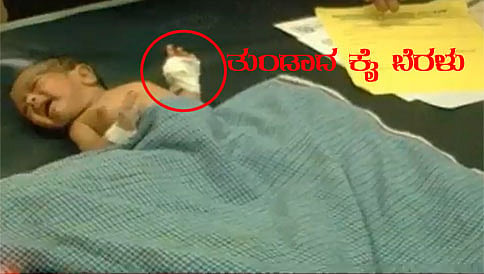 ಬ್ಯಾಂಡೇಜ್ ತೆಗೆಯಲು ಹೋಗಿ ಹೆಬ್ಬರಳೇ ಕಟ್