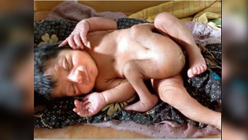 ರಾಯಚೂರು: ನಾಲ್ಕು ಕಾಲುಗಳುಳ್ಳ ಶಿಶು ಜನನ!