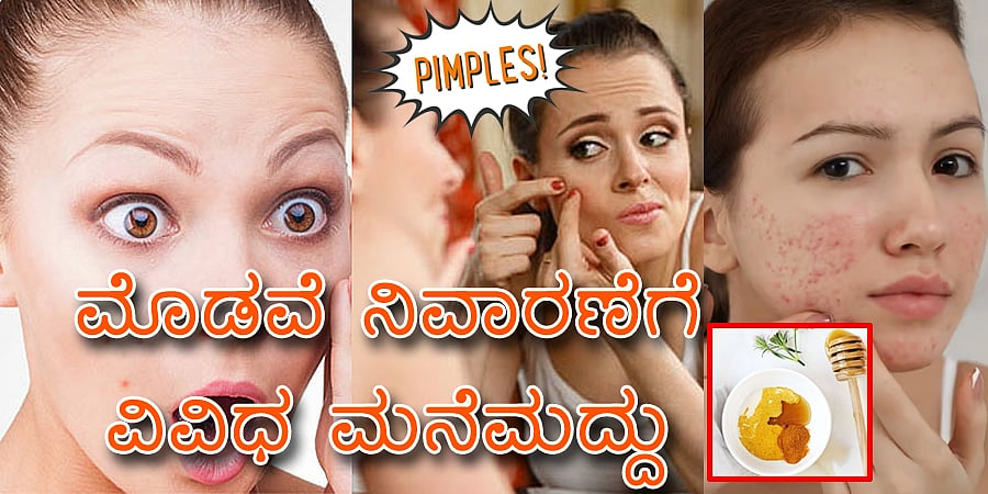 ಮೊಡವೆ: ಪಿಂಪಲ್ಸ್ ನಿವಾರಣೆಗೆ ಸಿಂಪಲ್ ಮನೆಮದ್ದು